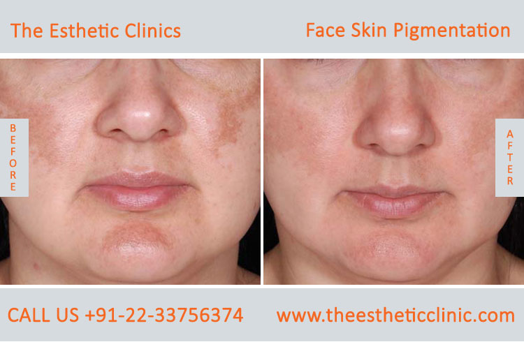 Face Skin Pigmentation Laser Treatment before after photos in mumbai india (1)